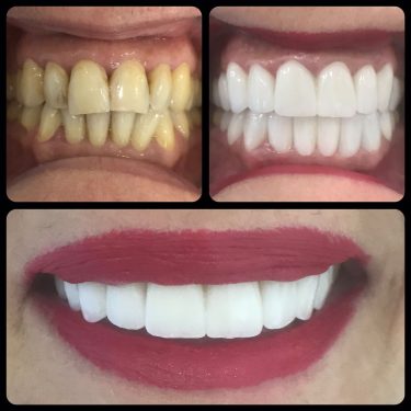 3D Gülüş Tasarımı