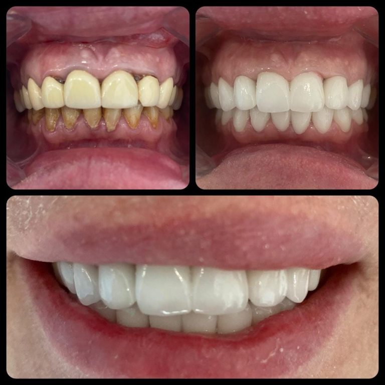 3D Gülüş Tasarımı