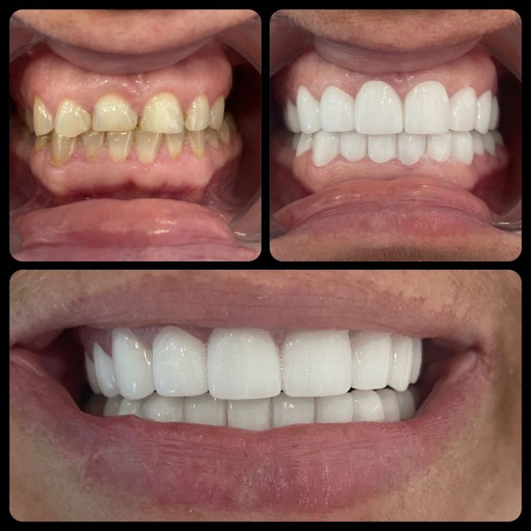 3D Gülüş Tasarımı