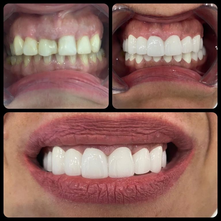 3D Gülüş Tasarımı