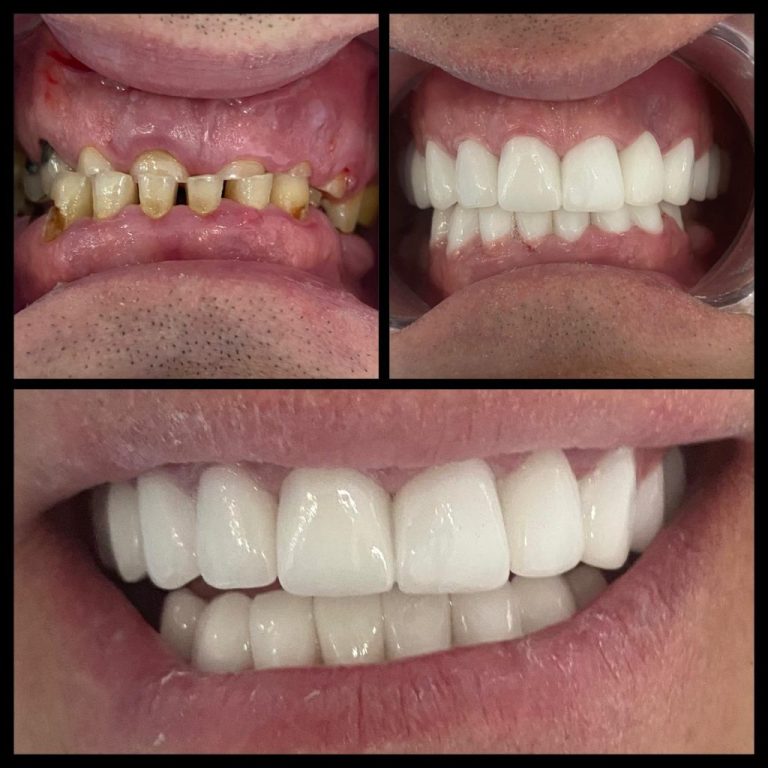 3D Gülüş Tasarımı