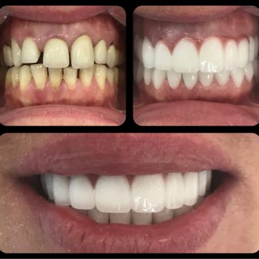 3D Gülüş Tasarımı